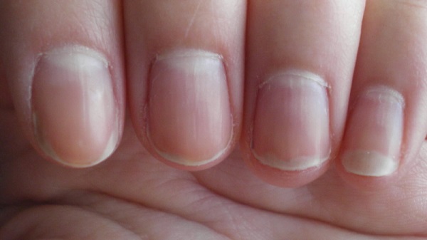 6 Things Your Fingernails Can Say About Your Health